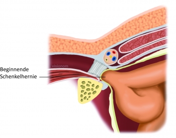 Perioperative management - Femoral hernia repair – TIPP technique