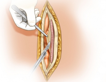 Open incisional hernia repair